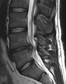 94px-L4-l5-disc-herniation